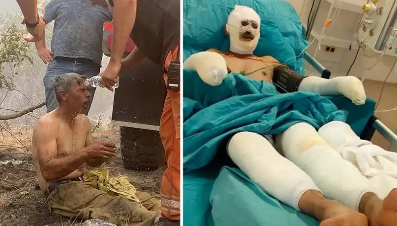 Yanıyorum Diye Feryat Eden Orman İşçisinin Sağlığı İçin Seferberlik Başladı